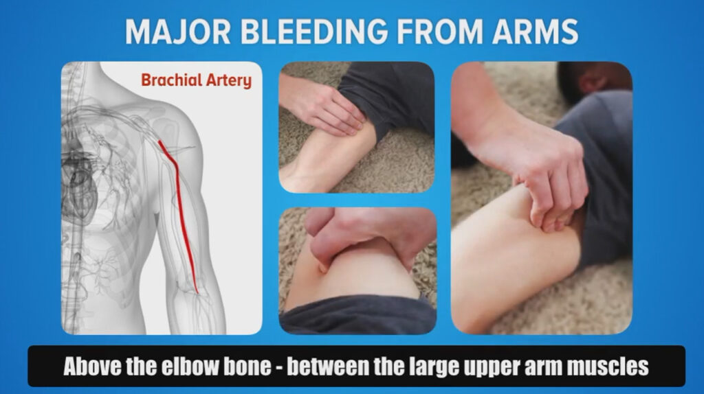 Infographic on how to stop major bleeding from arms for an active shooter response plan.