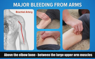How to Respond to Injuries