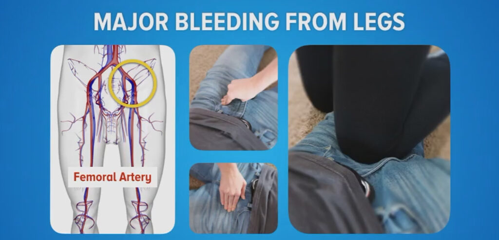 An infographic on how to stop major bleeding from the legs for an active shooter response plan.